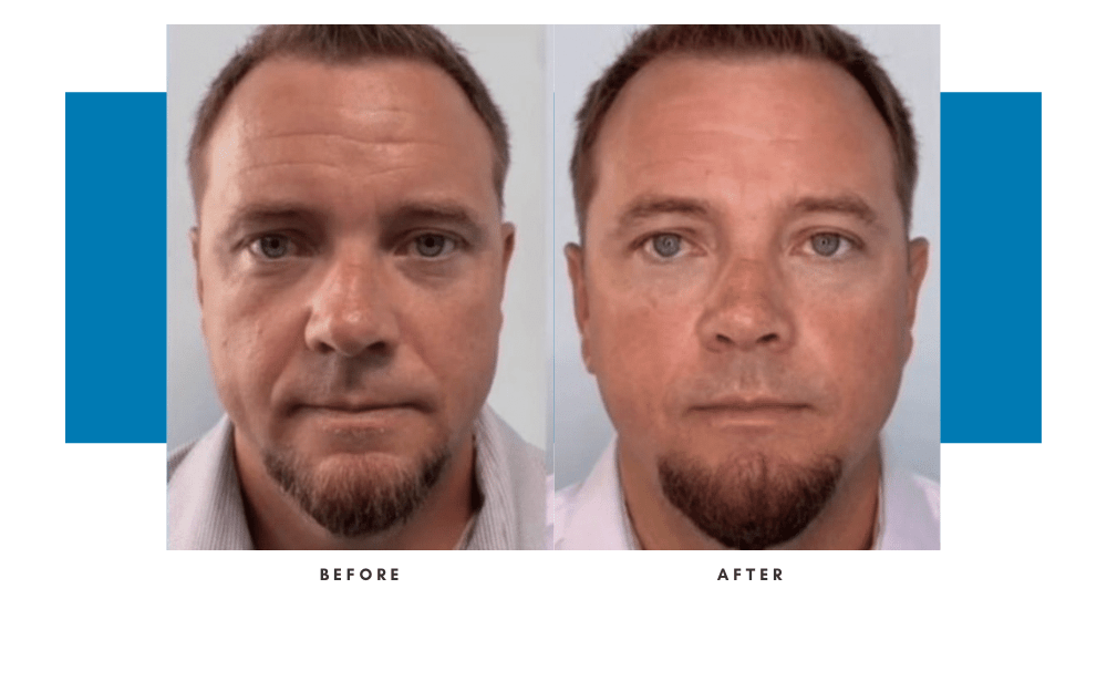 emface-before-and-after-2