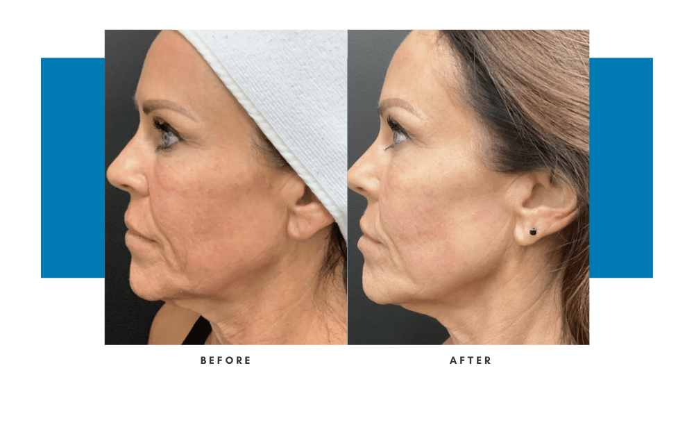 emface-before-and-after-3