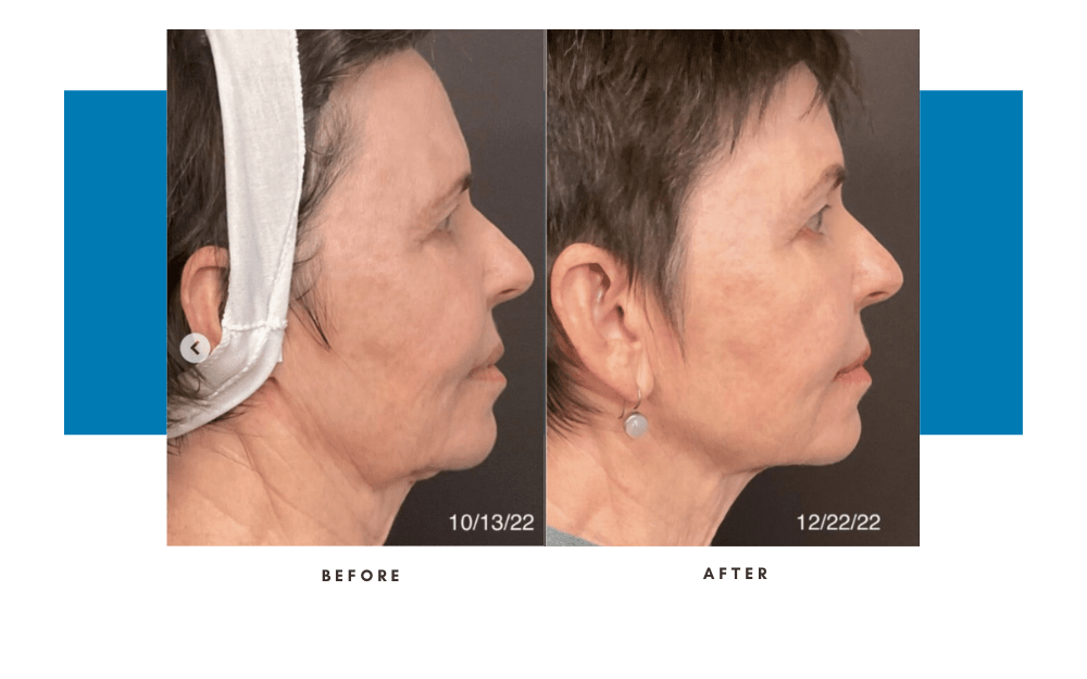 emface-before-and-after-4