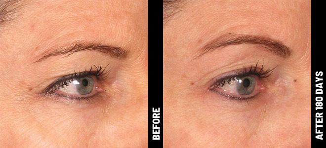 Ultherapy Brow Lift