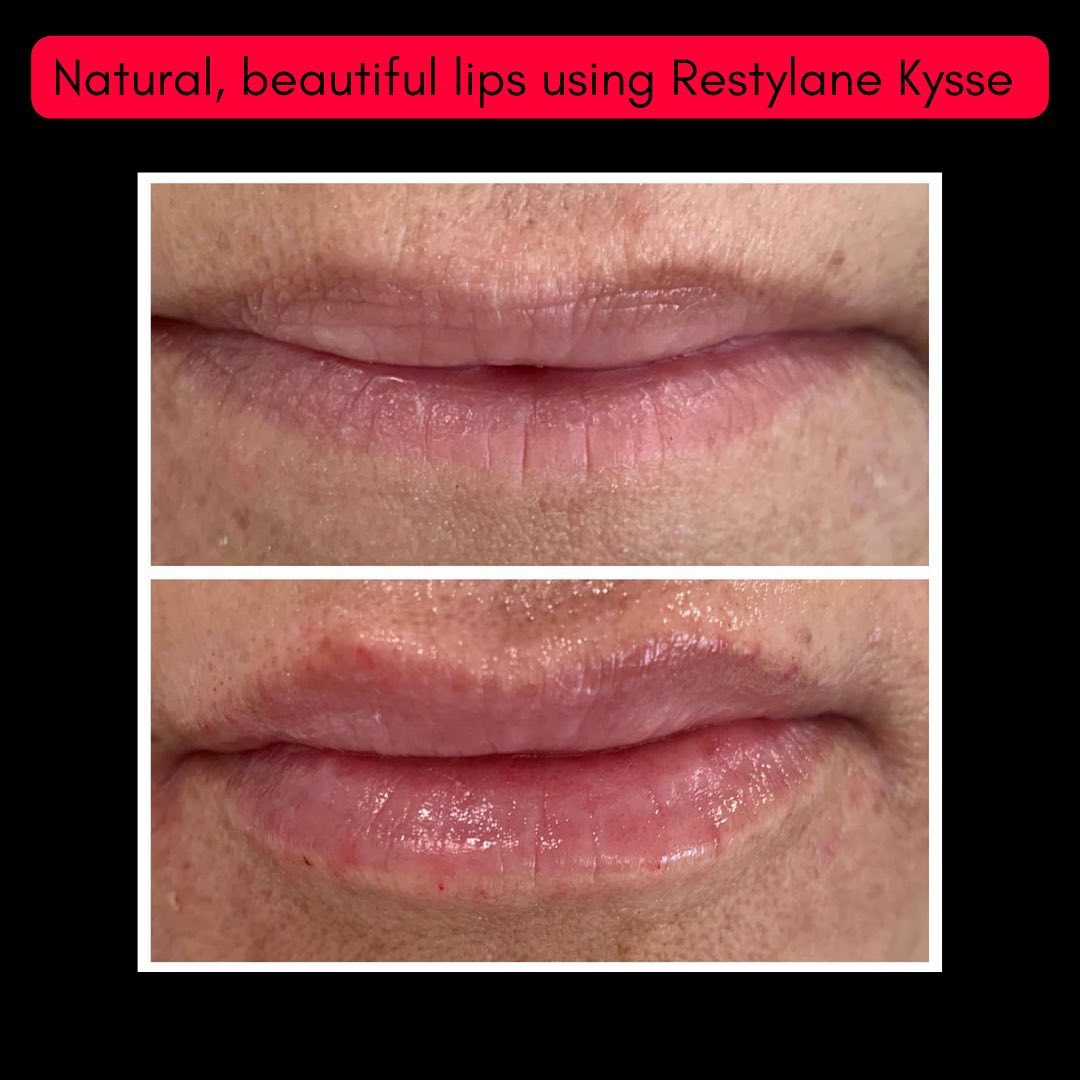 before-after-restylane
