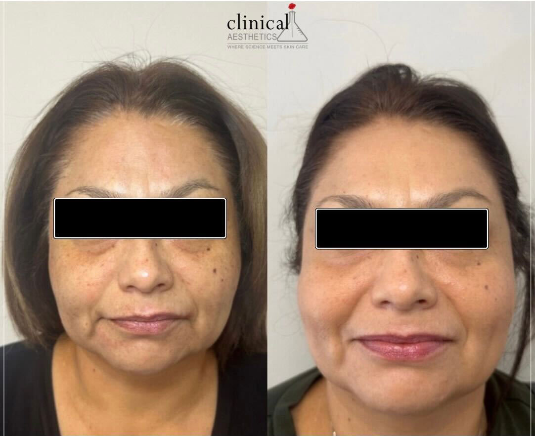 Genesis Before/After